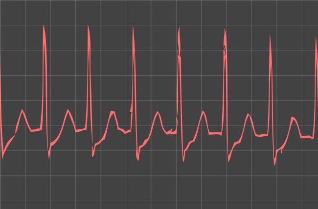 What is Supraventricular Tachycardia?